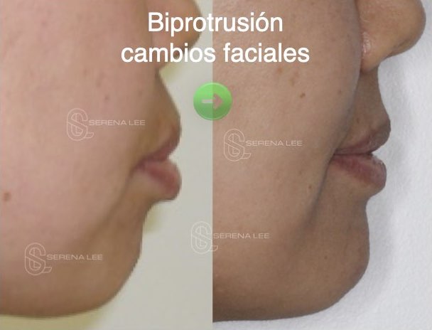 biprotrusion cambios faciales
